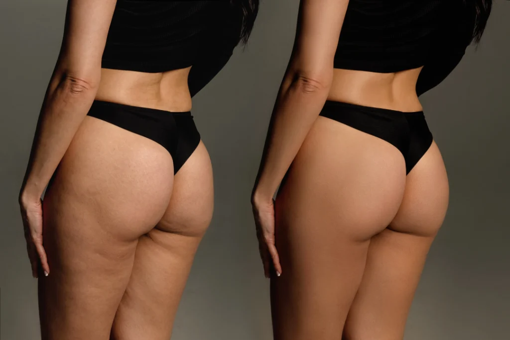 Visible reduction in cellulite on thighs and buttocks through BodyFX treatment.