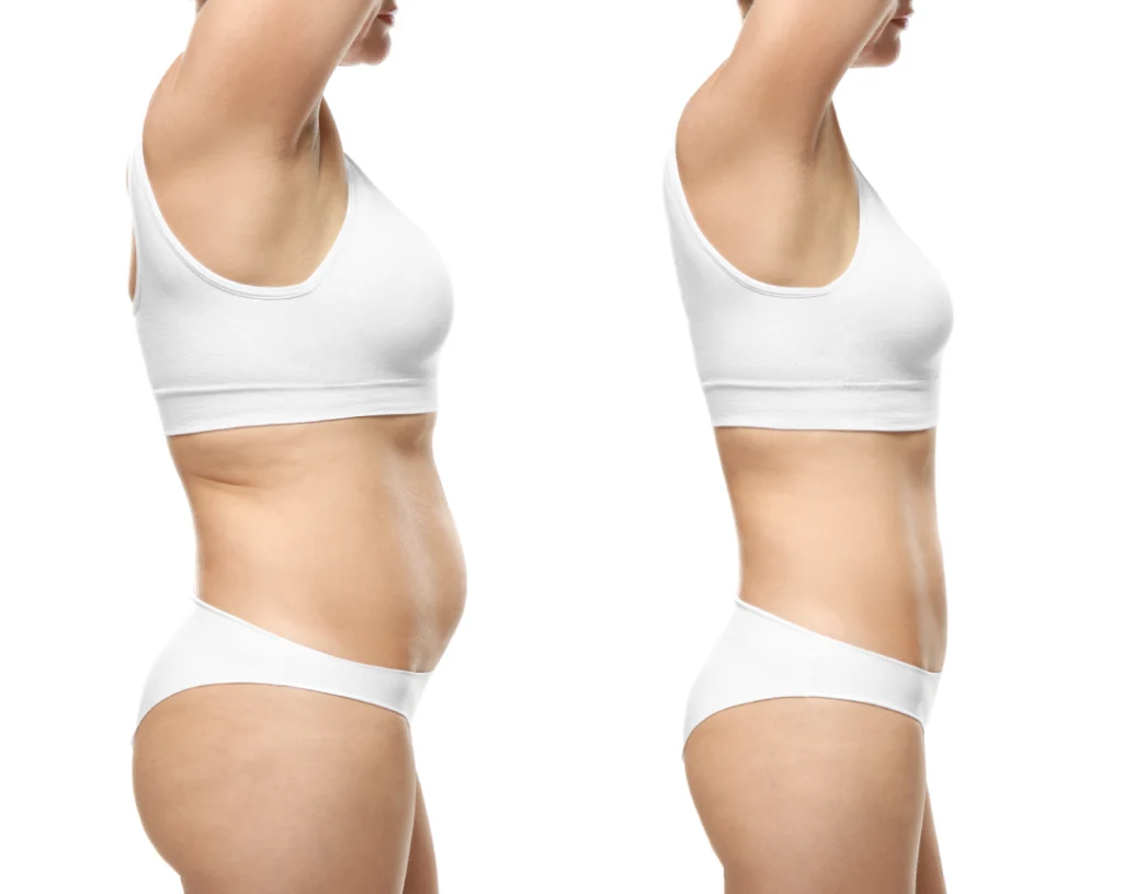 Before and after results showing a flatter abdomen achieved with BodyFX treatment.