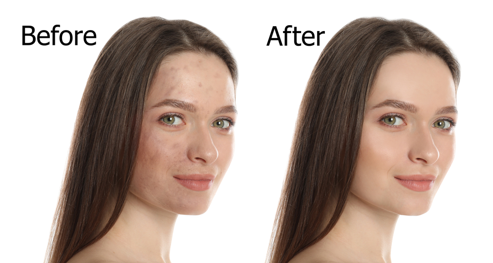 Before and after results of a chemical peel highlighting improved skin clarity.