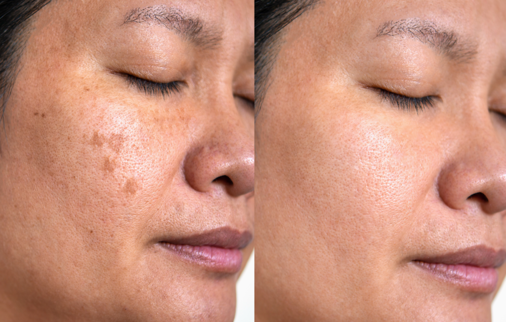 PRP Microneedling before and after facial results.