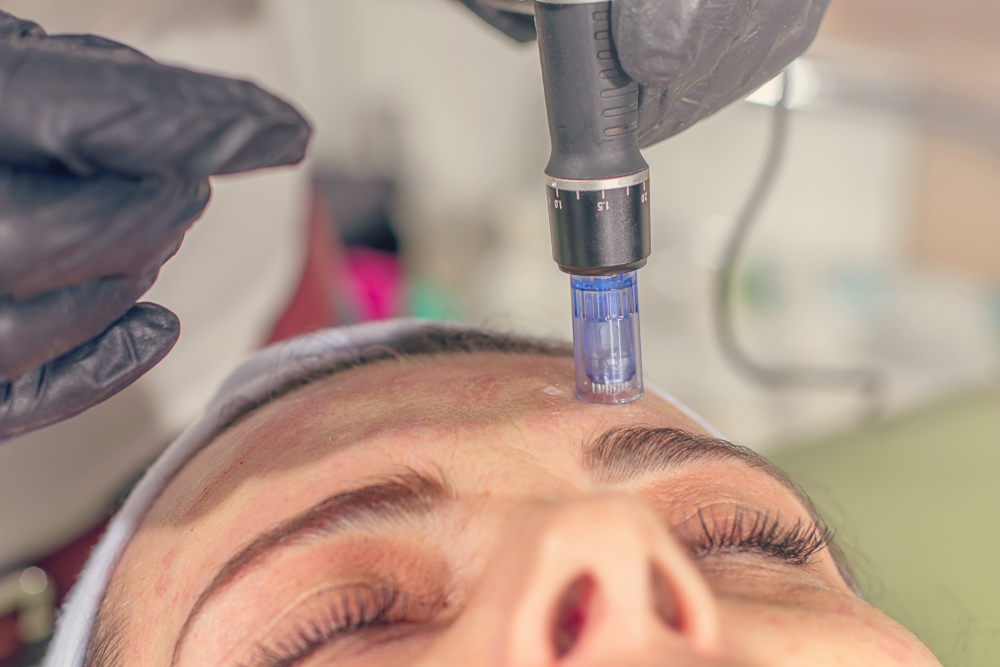 PRP Microneedling session being performed on a patient's forehead.