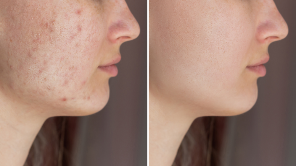 Side-by-side facial acne results showing skin before and after treatment